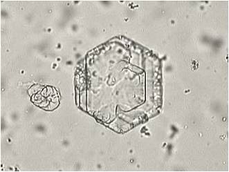 Cristais na urina | Biomedicina PadrÃ£o
